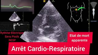 Arrêt CardioRespiratoire Échographie [upl. by Htebazie]