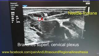 Lt side superficial cervical plexus block [upl. by Shelley952]