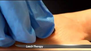 Hospital Uses Leeches to Heal Patients [upl. by Gisella]