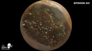 241  Ear Wax Removal in Stenotic Ear Canal using the WAXscope®️ [upl. by Nav]