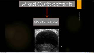 all things adnexal ovarain mass Imaging IOTA algorithm ACR ORADS GIRADS [upl. by Enitsirt]