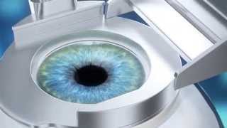 Super LASIK  визуализация процесса коррекции зрения [upl. by Harrak]