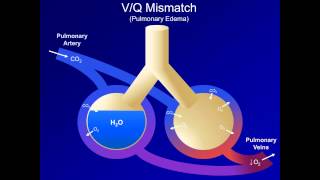 Hypoxia and Hypoxemia Mechanisms and Etiologies ABG Interpretation  Lesson 18 [upl. by Tenaj]