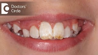 How do you treat Dental Fluorosis  Dr Aniruddha KB [upl. by Revlys]