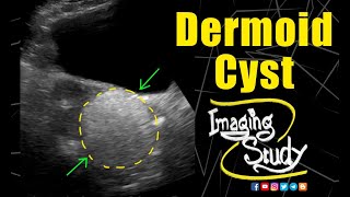 Dermoid Cyst  Ultrasound  Case 164 [upl. by Ardnuahs739]