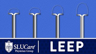 Loop Electrosurgical Excision Procedure LEEP to Remove Abnormal Cells  SLUCare OBGYN [upl. by Verner]