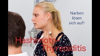 Hashimoto Healing  Narben lösen sich auf [upl. by Hawger]