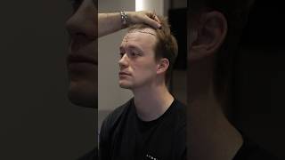 Cosmedica Clinic Hair Transplant in Turkey shorts hairtransplant video [upl. by Siraf]