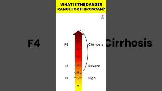 What is the danger range for FibroScan  Fibroscan  Liver Fibrosis Treatment viral hepatitis [upl. by Fahland]