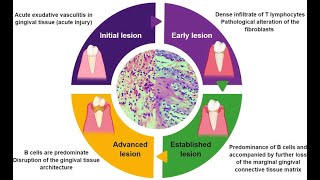 Periodontal Pathogenesis  Part 1 [upl. by Bailey]