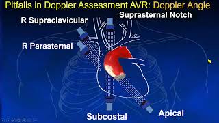 ASE 2021 Evaluation of Prosthetic Aortic Valve [upl. by Boulanger614]