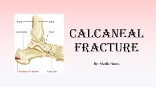 Calcaneal fracture  clinical features Sanders classification investigation treatment [upl. by Kappenne910]