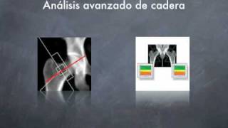 DIAGNOSTICO PRECOZ OSTEOPOROSIS [upl. by Panchito]