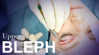 Upper Eyelid Blepharoplasty [upl. by Latsyk919]