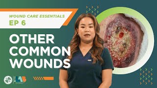 Wound Care Essentials Video 6 – Other Common Wounds [upl. by Akram]