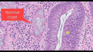 The Diagnosis of a Tubular Adenoma [upl. by Kussell586]