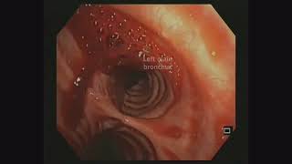 Successful multidisciplinary urgent management of bleeding after EUSguided fineneedle biopsy [upl. by Mel]