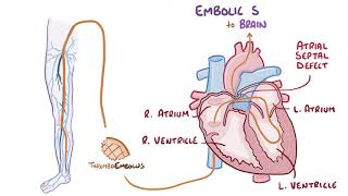 Deep vein thrombosis causes symptoms diagnosis treatment pathology [upl. by Eppie279]