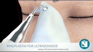 ¿Cómo se realiza las operaciónes de rinoplastia cerrada Guncel OzturkMD DRGO [upl. by Gable236]