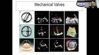 2024 07 12 21 03 02 Prosthetic Valve  MVPS by Dr Rakesh Gupta [upl. by Netsirc]