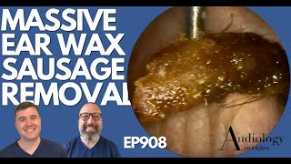 MASSIVE EAR WAX SAUSAGE REMOVED FROM PATIENTS EAR  EP908 [upl. by Elkraps]