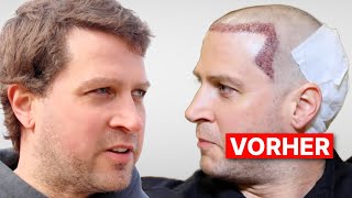 Die Wahrheit über Jans Haartransplantation nach 5 Monaten  Erfahrung und Ergebnis [upl. by Tychonn]