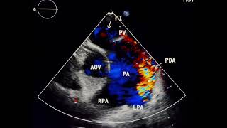 Patent ductus arteriosus to drahmadmirdamadisiomBJXyOSRxfgQGe5 [upl. by Ferullo]