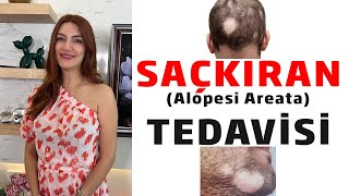 Saçkıran  Alopesi Areata  Tedavisi [upl. by Oirasor772]