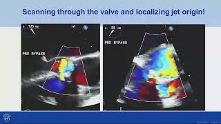 Echo Assessment of Aortic Valve Prosthesis Regurgitation [upl. by Ardath]