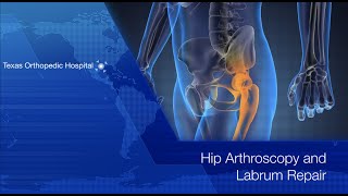 Hip Arthroscopy and Labrum Repair  Dr Gombera [upl. by Coretta950]