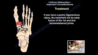 Lisfranc Dislocation Important Considerations  Everything You Need To Know  Dr Nabil Ebraheim [upl. by Fusuy]