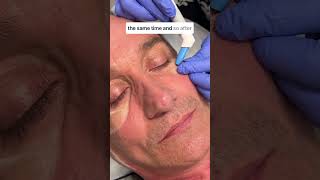 Precision Skin Tightening for Under the Eyes and Beyond [upl. by Alimaj]