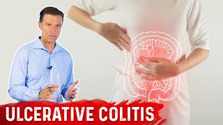 What is Ulcerative Colitis – Causes Symptoms amp Treatment by DrBerg [upl. by Atirahs]