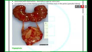 UGS Pathology  Anomalies amp Cystic Kidney Diseases  Mutah [upl. by Atinauj957]