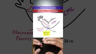 Olecranon Bursitis orthopedics inicet neetpg [upl. by Zilada]