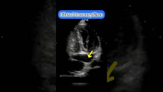 Coronary Sinus on Echocardiography echocardiogram cardiology echo [upl. by Nylorahs]