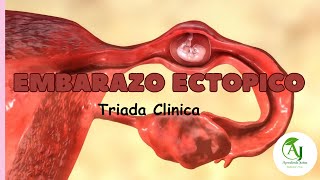 Embarazo EctópicoTriada Clínica [upl. by Tenneb214]