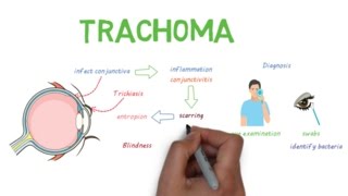 Trachoma  a devastating infectious eye disease [upl. by Esinart]