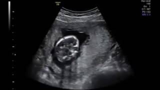 PAPADIMITRIOU – 12 weeks Chorionic Villus Sampling CVS [upl. by Khalil619]