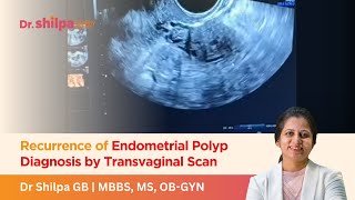 Recurrence of Endometrial Polyp Diagnosis by Transvaginal Scan  Dr Shilpa G B [upl. by Eellehs]