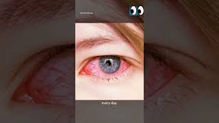 Topic Conjunctivitis  adibarani6113 [upl. by Favianus]