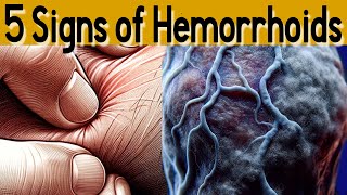 5 signs and symptoms of Hemorrhoids and treatment [upl. by Gall]