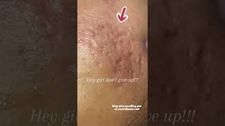 Effective method for removing deep acne scars [upl. by Sholes344]