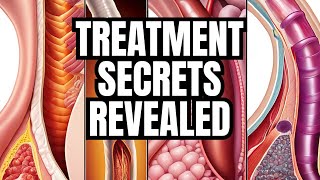 Barretts Esophagus Secrets to Treatment [upl. by Seidnac]