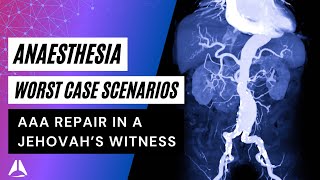 Elective AAA repair in a Jehovahs Witness  anaesthesia Exam Case anesthesiology exam [upl. by Manlove]