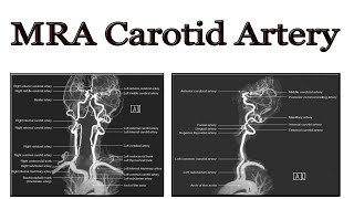 MRA carotid artery [upl. by Francis]