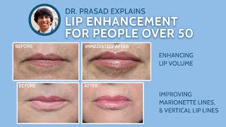 Why Lip Enhancement Over Age 50 Needs More than Lip Fillers [upl. by Notyalk]