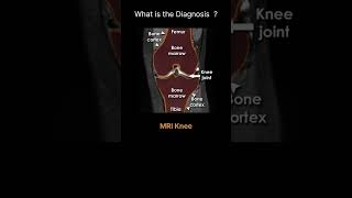 MRI Knee Quiz 2 radiologychannel007 [upl. by Suriaj531]