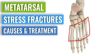 Metatarsal Stress Fractures  Causes Treatment Prevention [upl. by Llevram]