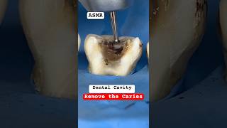 Remove the Caries cavity teethsmiledrmassidental [upl. by Aret544]